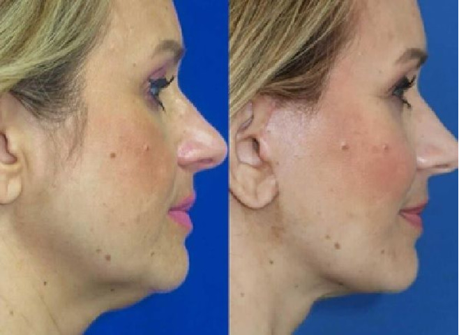 Lifting facial – spune adio ridurilor profunde — foto 2