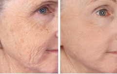 Tratament cu laser regenerarea pielii si eliminarea ridurilor in cabinetul de chirurgie laser “Laser