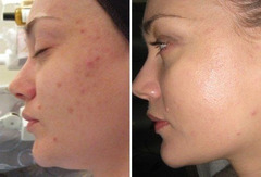 Remodelarea cutanata cu laser (peeling-ul cu laser, lasabraziune, resurfacing) in Moldova!