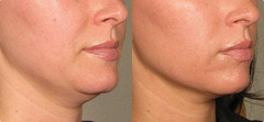 Corectarea barbiei duble! 30% reducere!   Revolutia frumusetii:  3D HIFU - High Intensity Focused Ul - Изображение 2