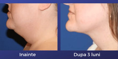 Liposuctia laser: eliminarea barbiei duble - Изображение 3
