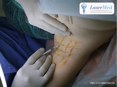Tratamentul cu laser a hiperhodrozei axilare in Moldova! - Изображение 3