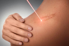 Tratament cu laser pentru indepartarea si  eliminarea, (corectia) cicatricelor  in cabinetul de chir
