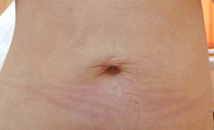 Tratamentul vergeturilor cu laser fractional in Moldova! - Изображение 3