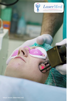 Лазерное омоложение лица (Лазерный пилинг лица) Лазерный пилинг лица  в Кишиневе, Молдове! - Изображение 2
