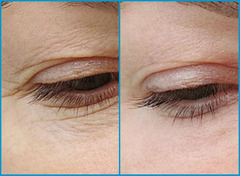 Blefaroplastie cu laser (Chirurgia laser estetica a pleoapelor) in (Chisinau) Moldova! - Изображение 5