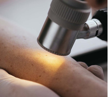 Tratamentul formatiunilor benigne cutanate cu laser in Moldova - Изображение 6