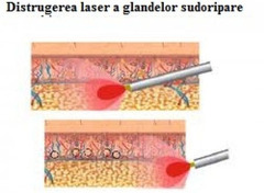 Tratamentul cu laser a hiperhidrozei axilare in Moldova - Изображение 5