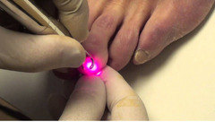 Tratament laser a onicomicozei (Infectia fungica a unghiei, micoza unghiilor) in Chisinau, Moldova! - Изображение 2
