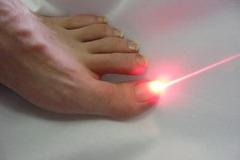 Tratament laser a onicomicozei (Infectia fungica a unghiei, micoza unghiilor) in Chisinau, Moldova! - Изображение 3