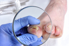 Tratament laser a onicomicozei (Infectia fungica a unghiei, micoza unghiilor) in Chisinau, Moldova! - Изображение 4