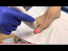 Tratament laser a onicomicozei (Infectia fungica a unghiei, micoza unghiilor) in Chisinau, Moldova! - Изображение 5