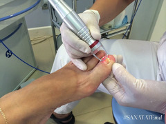 Tratament laser a onicomicozei (Infectia fungica a unghiei, micoza unghiilor) in Chisinau, Moldova! - Изображение 6