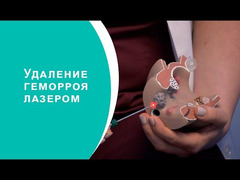 Лазерное удаление геморроя в Молдове, Кишиневе! - Изображение 3