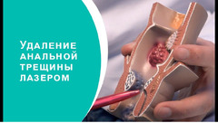 Лазерное лечение анальной трещины в Молдове, Кишиневе! - Изображение 2