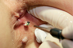 Tratament laser pentru vegetatiile veneriene (condiloamele, condyloma acuminata, negii genitali, con