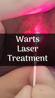 Tratament laser pentru vegetatiile veneriene (condiloamele, condyloma acuminata, negii genitali, con - Изображение 2