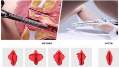 Chirurgia plastica intimă: injectarea cu acid hialuronic în punctul G (Augmentarea punctului G) in C - Изображение 3