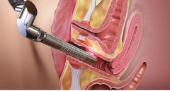 Chirurgia plastica intimă: injectarea cu acid hialuronic în punctul G (Augmentarea punctului G) in C - Изображение 6