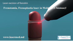 Circumcizia cu laser (ablatia laser a preputului) la bărbați în Moldova - Изображение 3