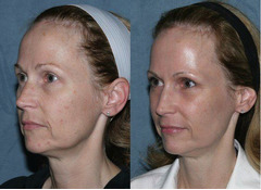 3D Hifu (High Intensity Focused Ultrasound), SMAS -лифтинг в Кишиневе! - Изображение 2